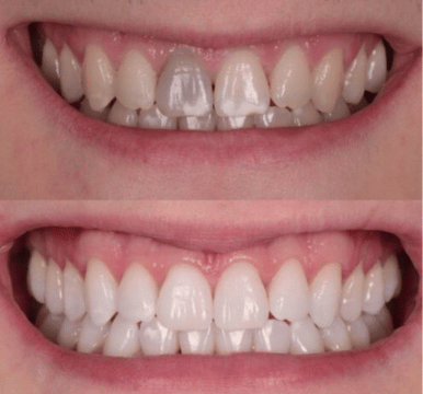 Leamingtonroad  Teeth Whitening Image
